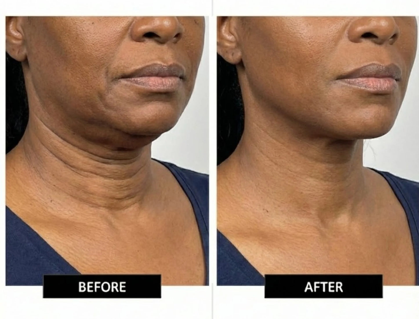 Numiere EMS Neck & Face Lift