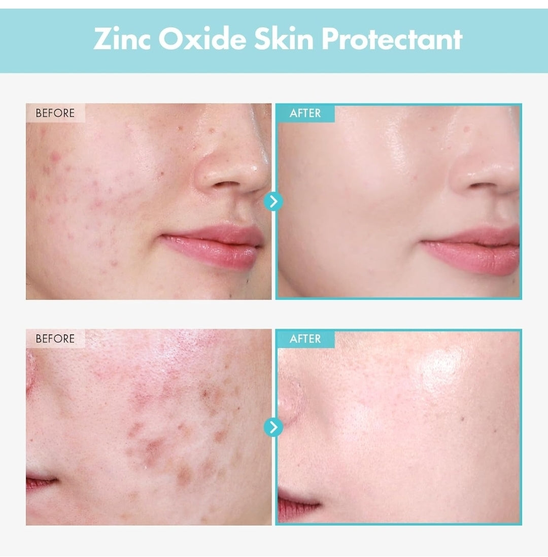 TOSOWOONG SOS Repair CICA Clinic Zinc Cream - 10% Zinc Oxide, Heal, Soothe Acne, Redness, Rosacea Treatment, Skin Barrier Repair, Moisture, Non-Comedogenic, Korean Skin Care