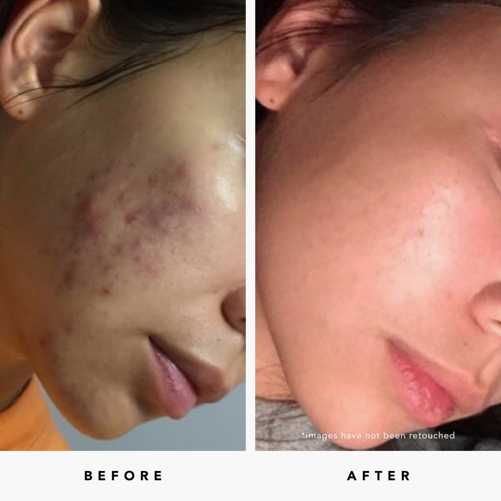 Herbivore Tansy Resurfacing Clarity Mask + Free Dr. Jart+ Soothing Hydra Solution Mask - Improves texture and reduces pore size in minutes