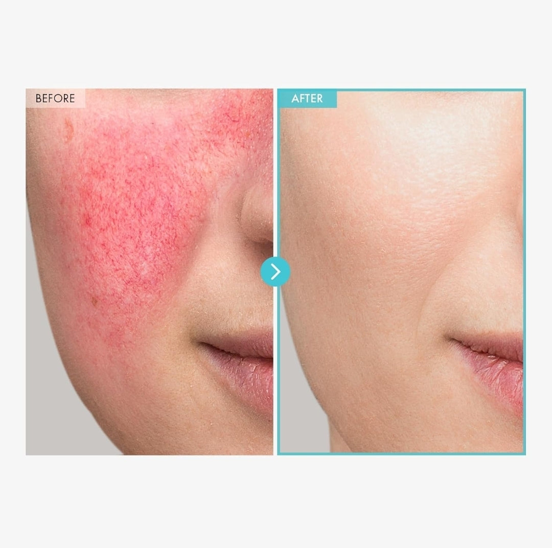 TOSOWOONG SOS Repair CICA Clinic Zinc Cream - 10% Zinc Oxide, Heal, Soothe Acne, Redness, Rosacea Treatment, Skin Barrier Repair, Moisture, Non-Comedogenic, Korean Skin Care