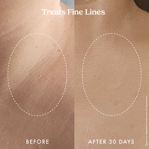 Kopari Ultra Renewal Retinol Body Cream, Infused with Acai & Encapsulated Retinol - Treats fine lines, sun damage & crepey skin