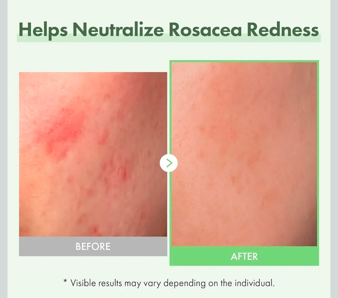 TOSOWOONG Azelaic Acid 10% Serum - Rosacea care, Redness Soothing and Blemish, Centella Asiatica for Acne-prone, Niacinamide, Hyaluronic Acid, Korean Skincare, Natural Color