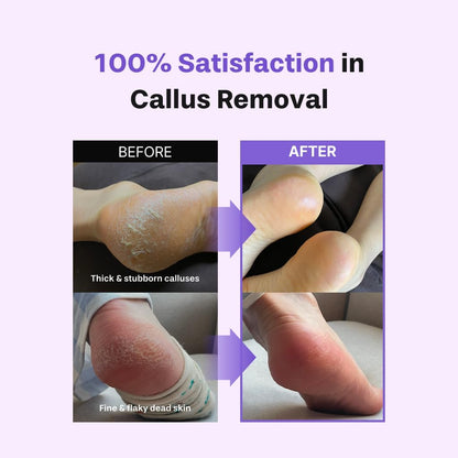 Baren Foot Callus Remover Kit, Instant Peeling Spray & Foot File for Heels