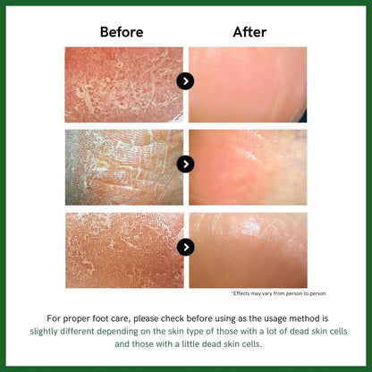 3WB Premium Foot Cream for Dry Cracked Heels Feet Knees Elbows Hands, Foot Dead Skin Cuticle Callus Remover Toenail Softener, Keratolytic Skin Barrier Repair Cream