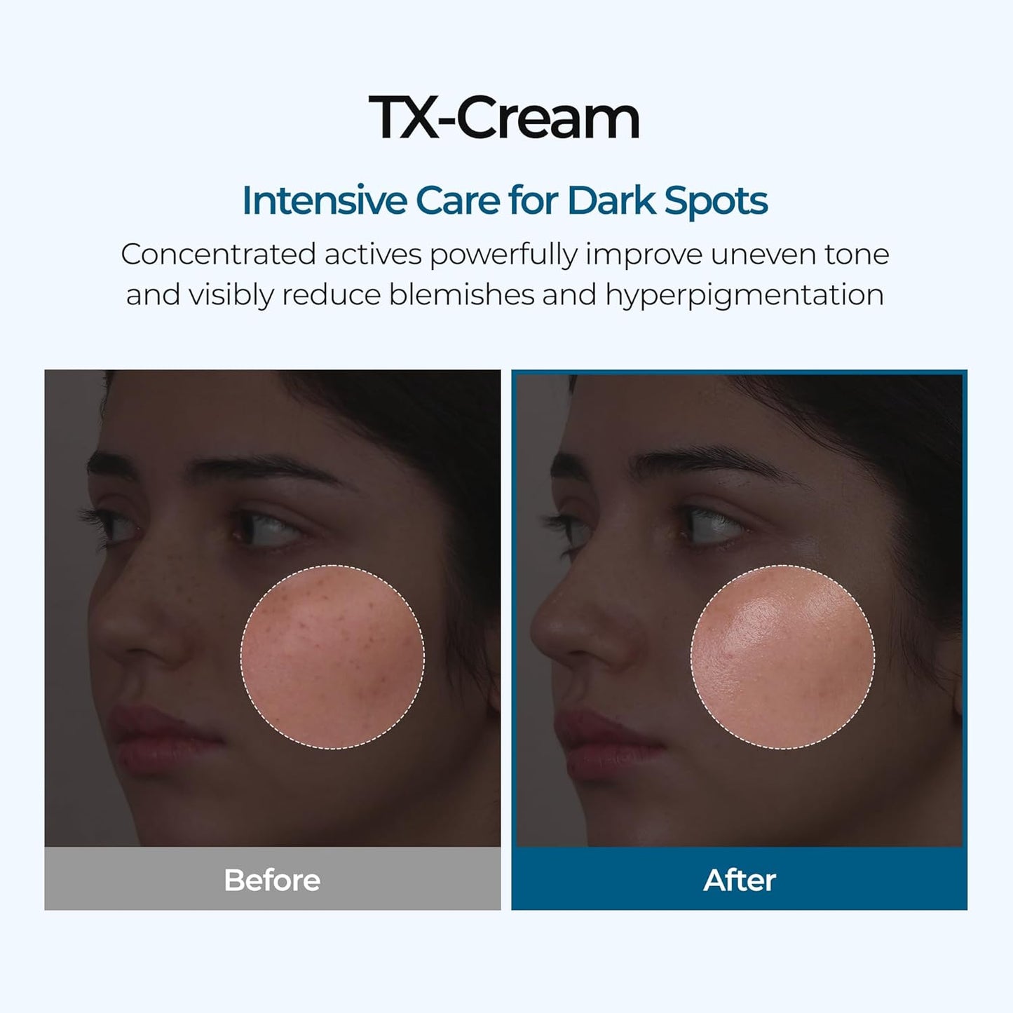 DR.Melaxin TX Tranexamic Acid CREAM, Skin freckle Cream, Blemishes, Anti-pigmetation korean skin care, Korean Cosmetics