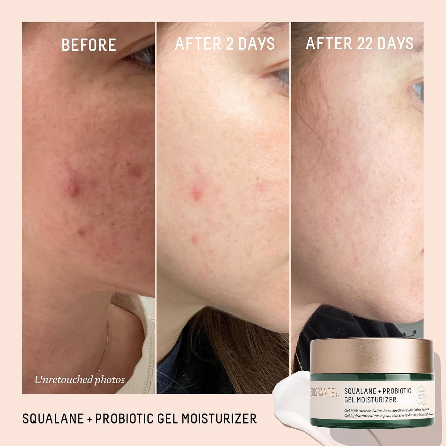 Biossance Squalane + Probiotic Balancing Face Gel Moisturizer - Advanced Formula for Oily & Acne-Prone Skin, Encapsulated Probiotics, Reduces Redness & Excess Oil, Soothes Sensitive Skin