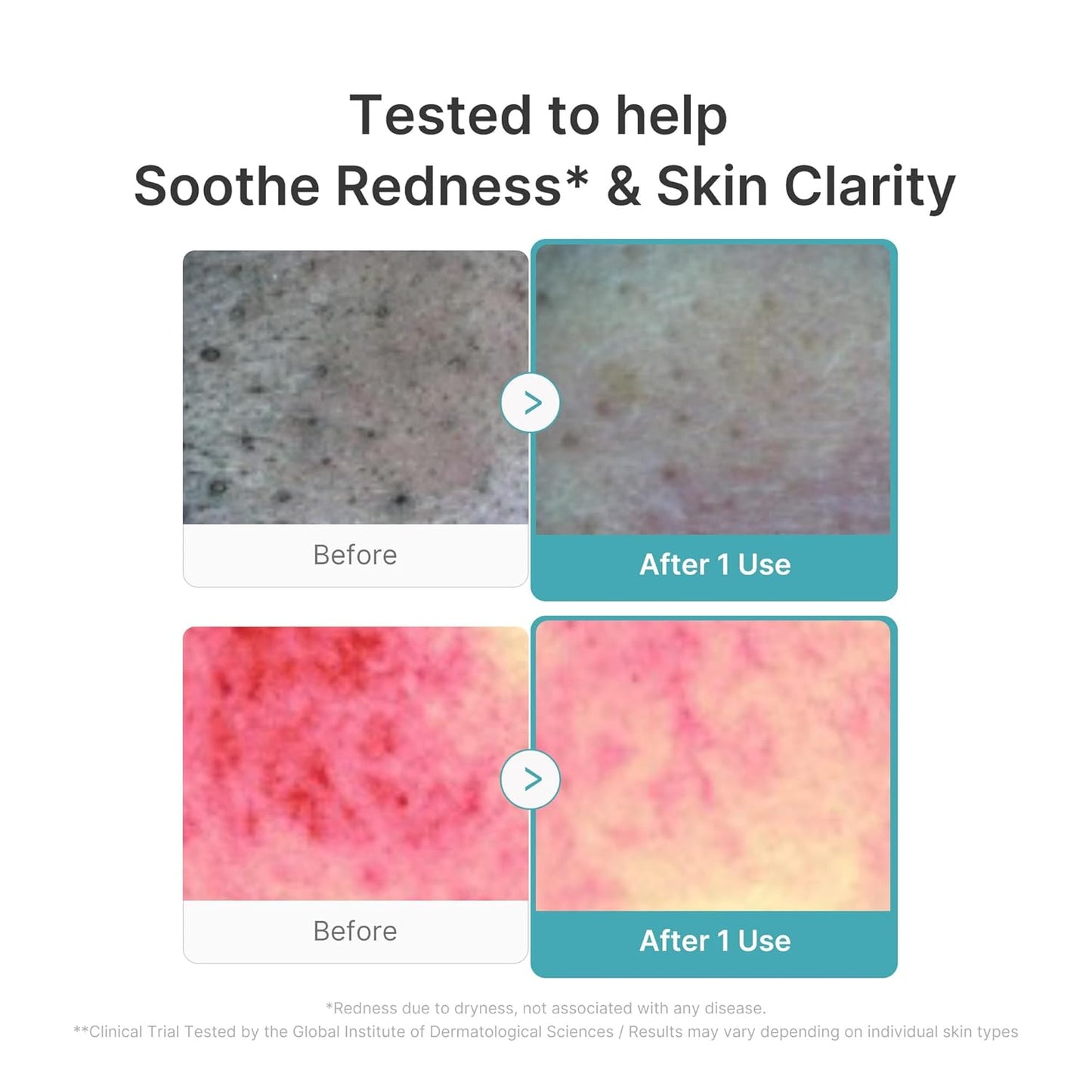 medicube Facial Cleanser Azelaic Acid Capsule Foam Cleanser | Soothing Daily Cleansing Foam For Troubled Skin & Excess Sebum Control | Uneven Skin with Niacinamide, Glycerin | Korean Skincare