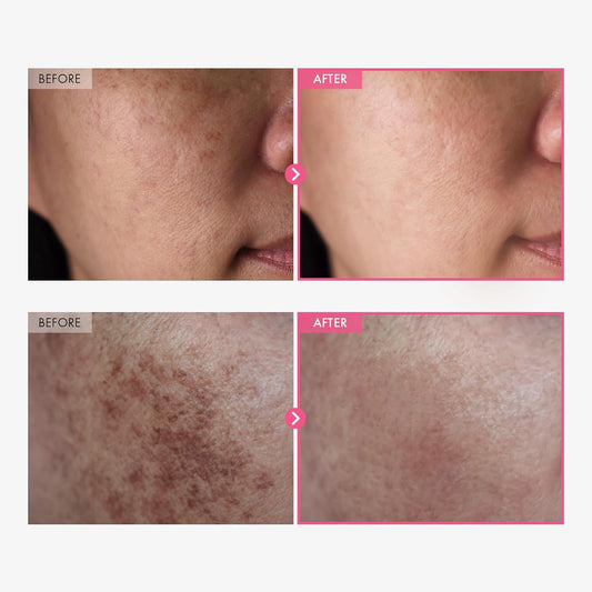 TOSOWOONG Arbutin 7% + Tranexamic Acid 4% Cream, 70,000ppm Arbutin, 40,000ppm TXA, Niacinamide, Glutathione, Dark Spots, Freckle, Blemishes, Pigmentation, Korean Skin Care