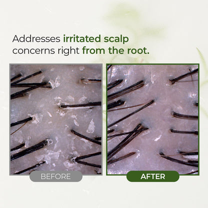 Tea Tree Scalp Treatment, Purifies and Exfoliates Oily Scalp, Natural BHA & Tea Tree, Removes Odor & Buildup, Hypoallergenic Exfoliator