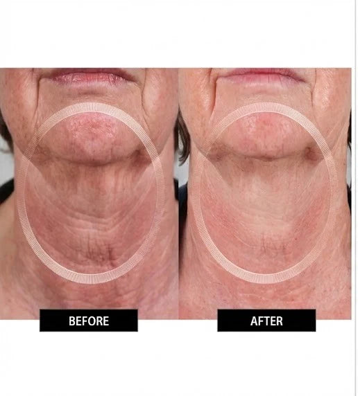 Numiere EMS Neck & Face Lift