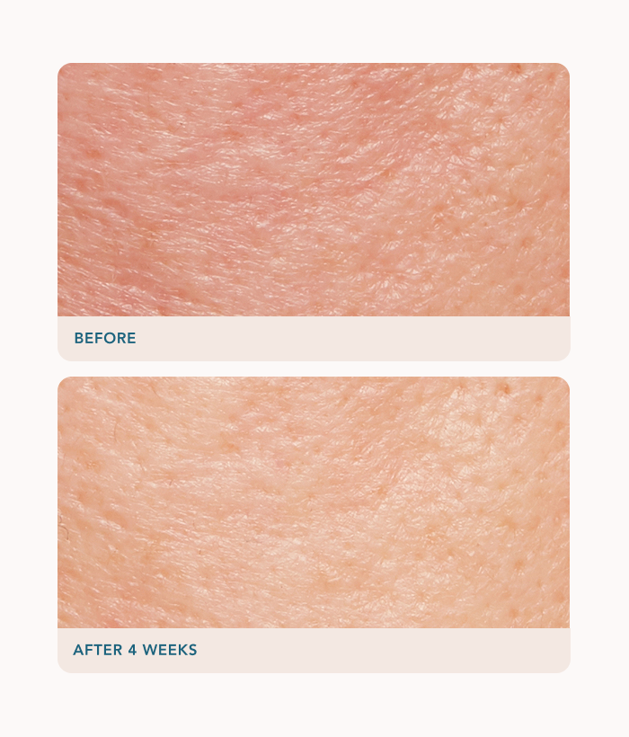 Lancer Skincare Retexturing Treatment Cream 50ml - Glycolic acid: An alpha-hydroxy acid that exfoliates rough and dead skin cells