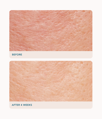 Lancer Skincare Retexturing Treatment Cream 50ml - Glycolic acid: An alpha-hydroxy acid that exfoliates rough and dead skin cells