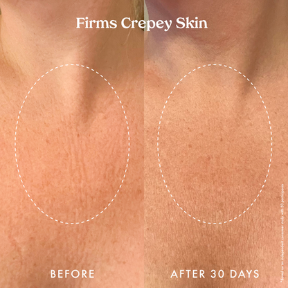 Kopari Ultra Renewal Retinol Body Cream, Infused with Acai & Encapsulated Retinol - Treats fine lines, sun damage & crepey skin