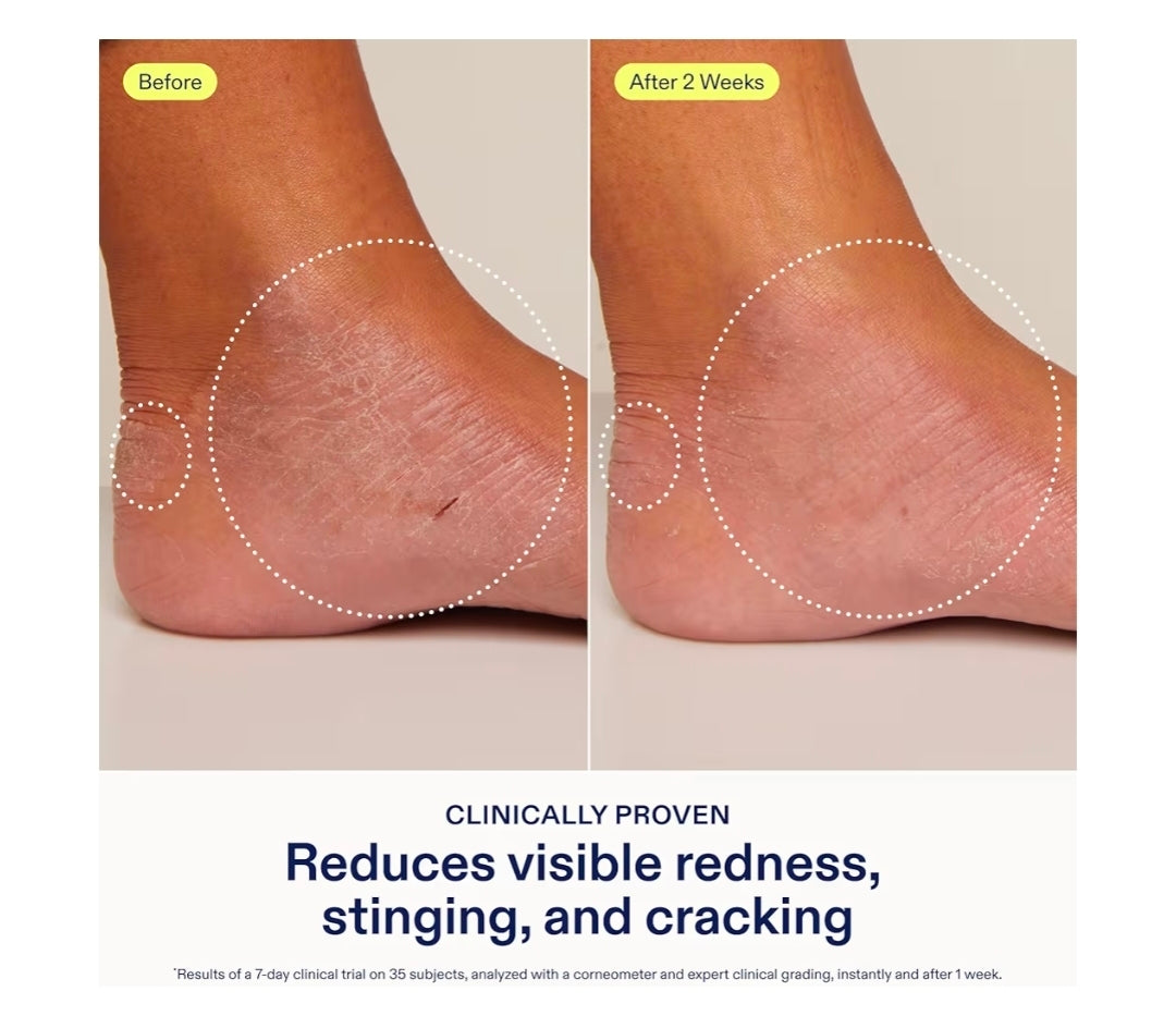 Crema para el alivio de manos Skinfix: reduce el enrojecimiento visible, el escozor y las grietas en pieles secas y sensibles. Aprobada por la Asociación Nacional del Eczema. Sin fragancia. Vegana y sin crueldad animal.