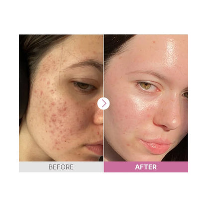 COSRX The Niacinamide 15 Face Serum: para poros dilatados, textura áspera de la piel, control del acné, hiperpigmentación