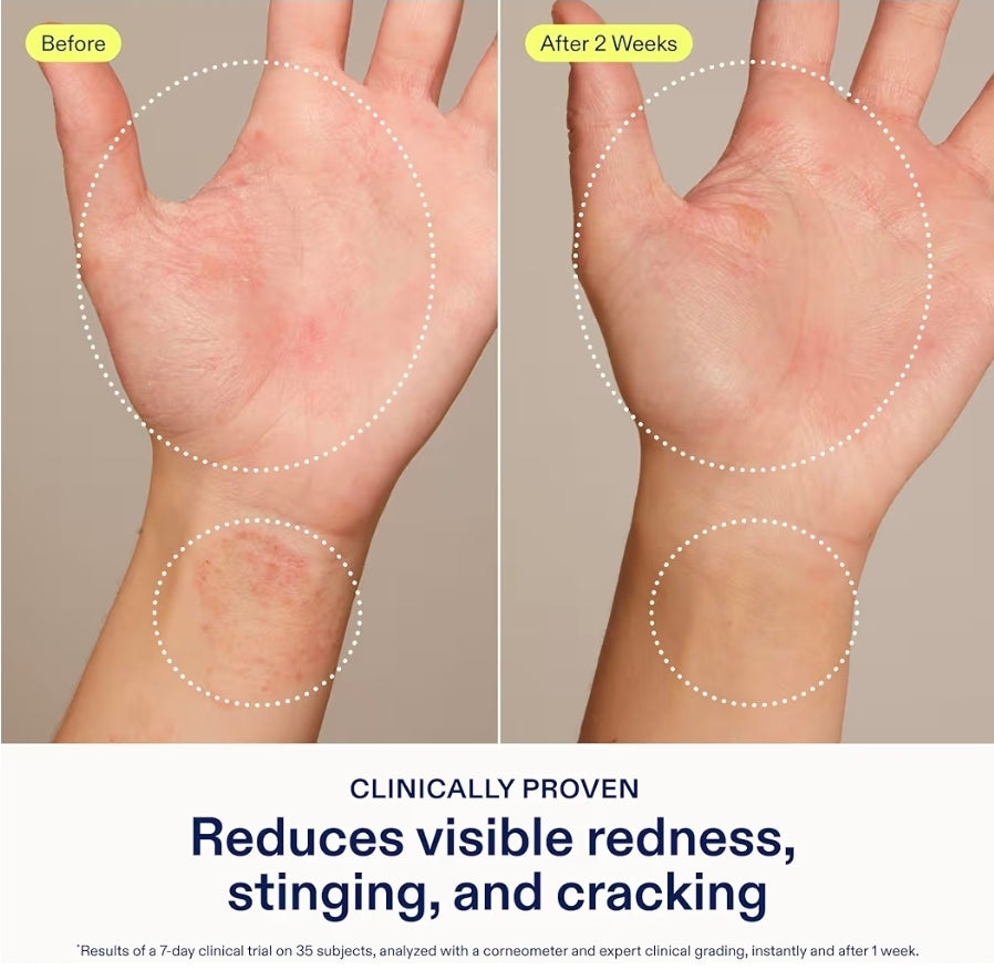 Crema para el alivio de manos Skinfix: reduce el enrojecimiento visible, el escozor y las grietas en pieles secas y sensibles. Aprobada por la Asociación Nacional del Eczema. Sin fragancia. Vegana y sin crueldad animal.