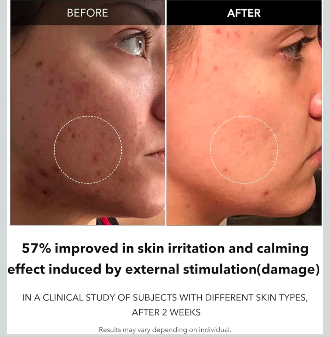 Suero facial clarificante de zanahoria APRILSKIN: corrector de manchas oscuras, aclarador de imperfecciones, vegano, no comedogénico, para piel grasa, sensible y con baches.