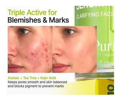 Suero facial PURITO con ácido azelaico al 10 % + ácido kójico + árbol de té: para acné, marcas y brotes, con alto contenido de ácido azelaico.